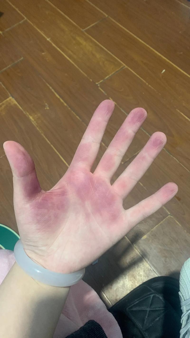 紫薯汁液手上怎么洗掉_紫薯染手巧清洗，油酒精风油精皆可试