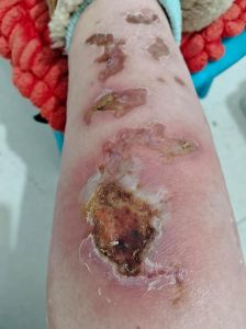 烫伤结痂处很硬很厚怎么处理_烫伤硬痂处理与预防感染