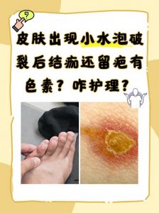 伤口结痂厚说明什么_伤口结痂厚怎么办？注意清洁防感染！