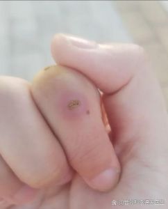 洗鱼时被鱼刺扎到手指如何处理_鱼刺扎手指？别慌，正确处理超简单！