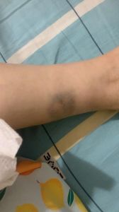 摔紫了一大片如何处理_胳膊咬伤变紫？冷敷热敷这样治恢复快！