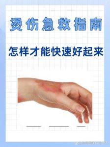 被油烫伤了怎么处理_冷水冲莫用冰破水疱勿撕