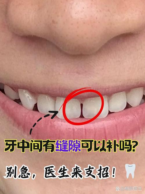 门牙突然中间有缝为什么_门牙缝变大怎么办？