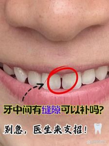 门牙突然中间有缝为什么_门牙缝变大怎么办？
