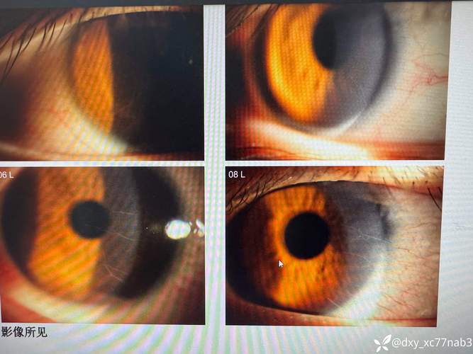 眼角膜卷丝是什么情况_角膜卷丝是什么原因及如何应对