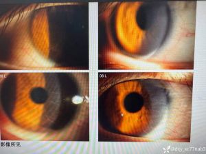 眼角膜卷丝是什么情况_角膜卷丝是什么原因及如何应对