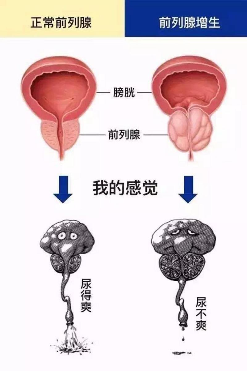 前列腺在哪个部位示意图_前列腺增生困扰中老年,定期检查很重要! 前列腺在哪个部位示意图_前列腺增生困扰中老年,定期检查很重要!