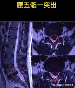 腰5-骶1椎间盘位置_保护腰部，远离疼痛
